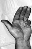 Little finger pulled towards the palm due to Dupuytren’s contracture