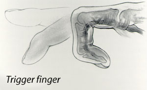 Diagram: Trigger Finger