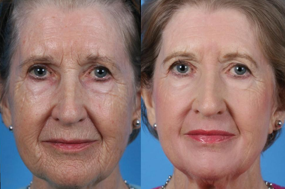 Before and After Photo: Skin Resurfacing