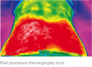 Post procedure thermography scan of the abdomen