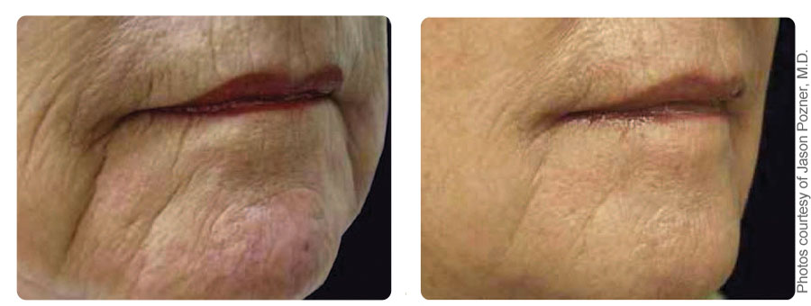 Before and after results for skin resurfacing on the chin