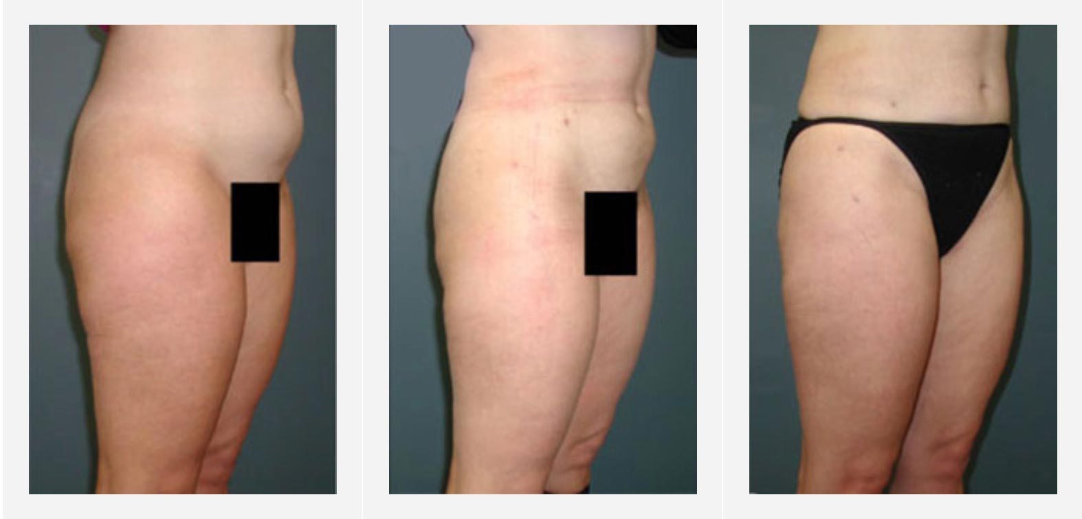 Before and after Liposuction