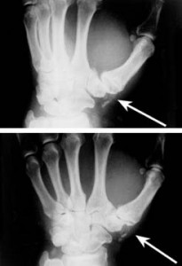 X-Ray of the thumb