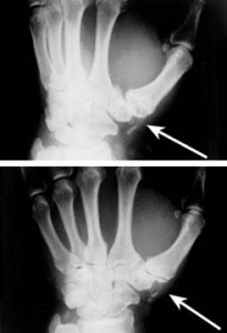 X-Ray of hands with arthritis