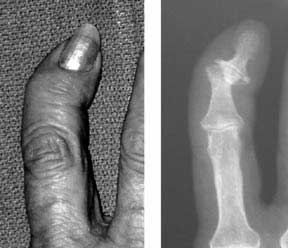 Little finger x-ray of bone