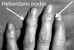 Heberden's nodes on the last join of fingers