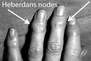 Heberden Nodes