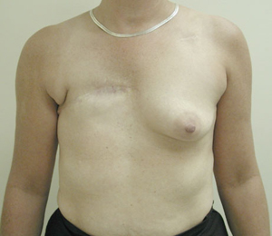 Latissimus Flap Figure 1