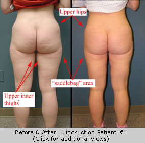 Lower body Liposuction Areas 