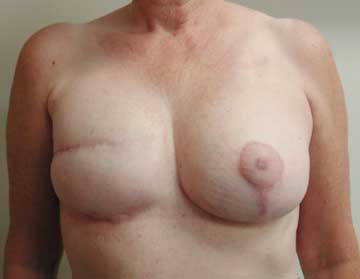 After Breast Lift Side View