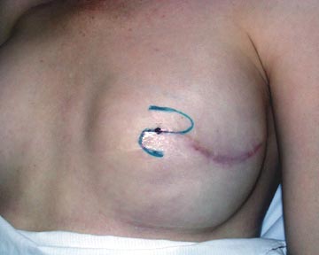 Nipple Reconstruction with S marking