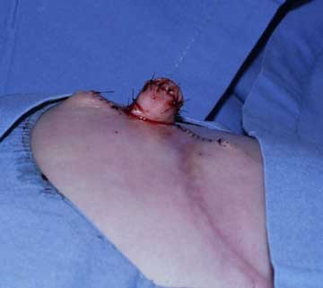 Figure 2 Nipple Reconstruction