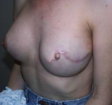 After Nipple Reconstruction 