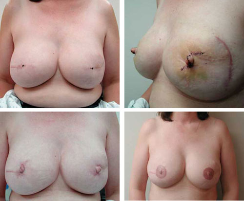 Nipple Reconstruction Before and After