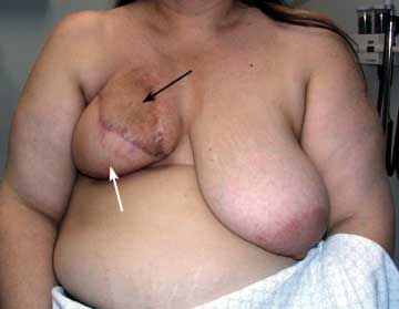 Breast Reduction Figure 1