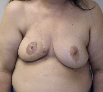 Breast Reduction Figure 2