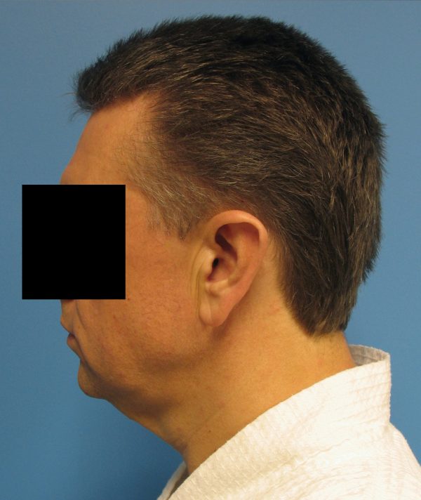 Neck Lift For Men Patient 002 Before After Columbia MO   632 A 600x712 