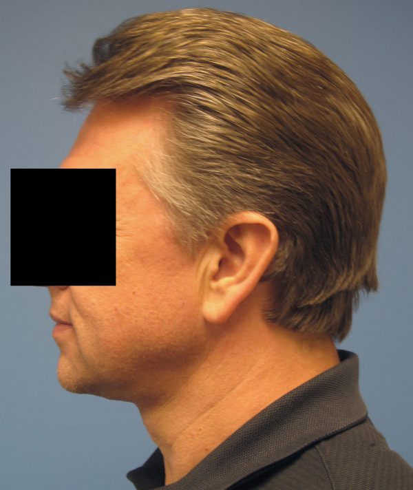 Neck Lift For Men Patient 002 Before After Columbia MO   632 B 600x712 