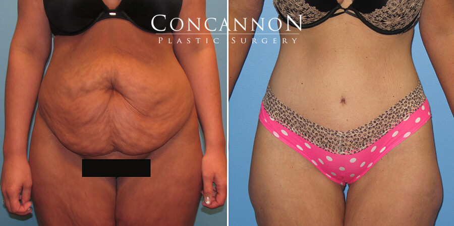 Concannon Plastic Surgery – Tummy Tuck - Columbia, MO
